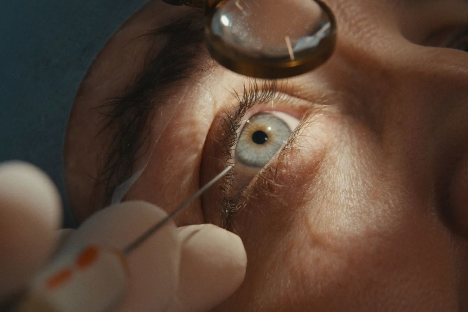 El ojo seco en cirugía de cataratas y refractiva: un desafío clínico infradiagnosticado