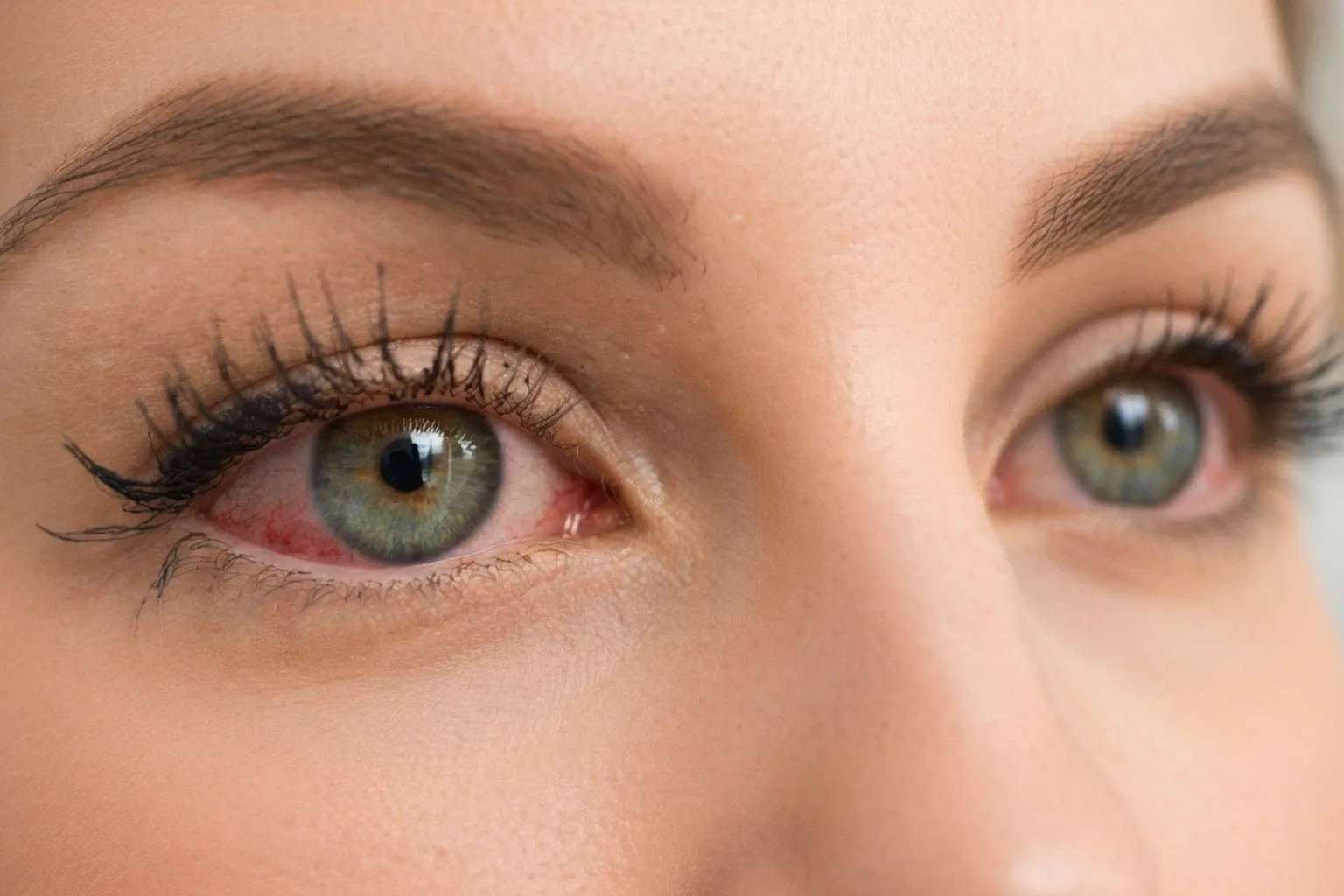 Riesgo de ojo seco tras la cirugía refractiva: por qué la PRK es más agresiva que el LASIK
